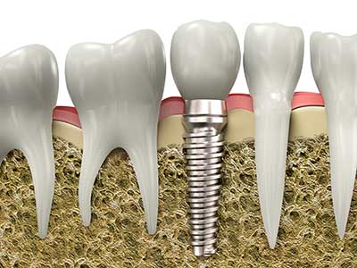 Dental Implants Kolhapur