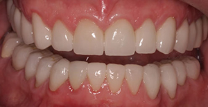 General Dentistry - Full Teeth Reconstruction ,Kolhapur