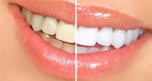 Csmetic Dentistry - Teeth Whitening ,Kolhapur