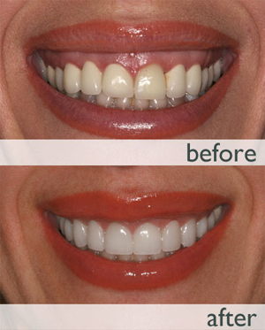 Gummy Smile Correction (Gum lift and Contouring)
